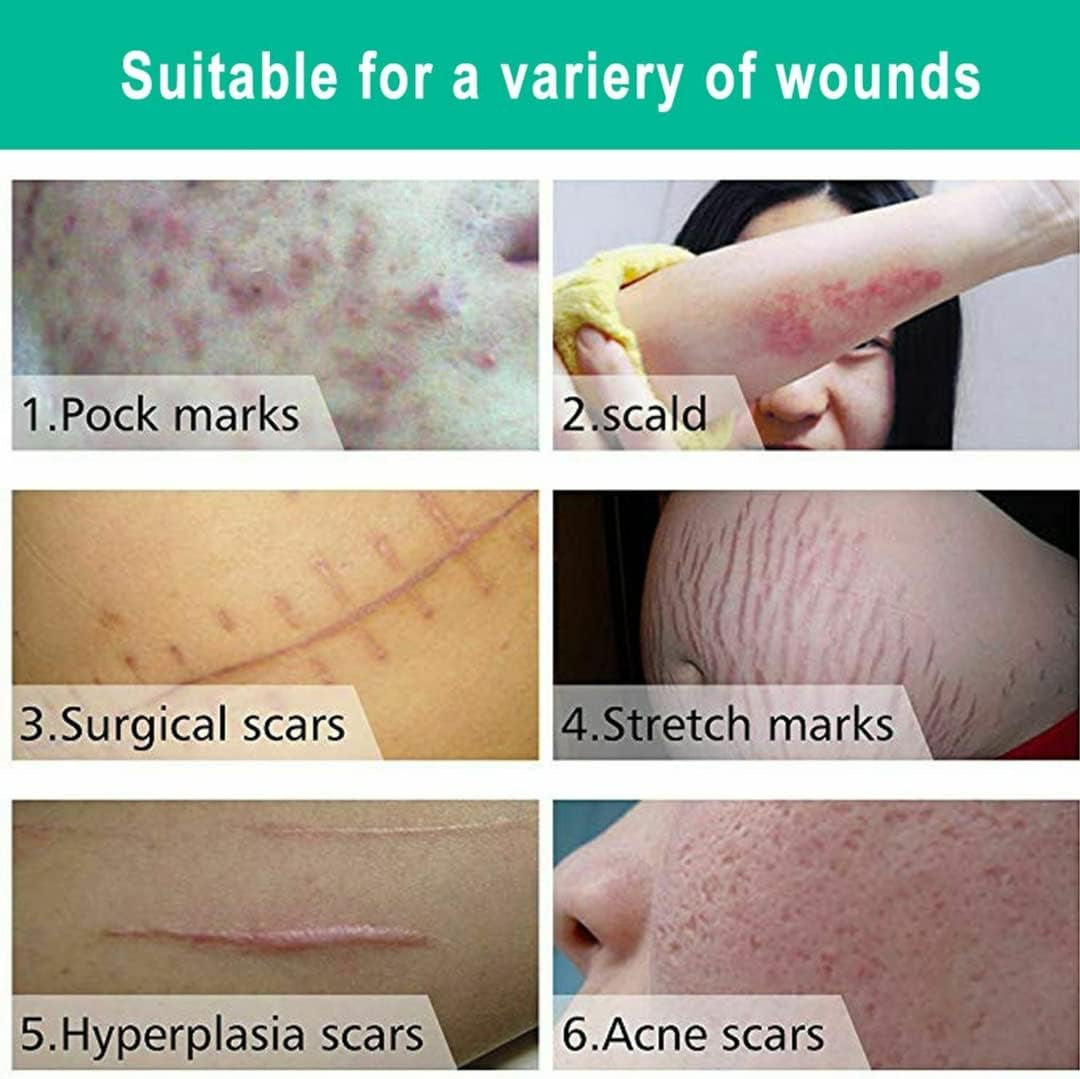 Scar Removal Cream New & Appearance of Old Scars Surgery, Stretch Marks, Acne, Burns & Injuries Face or Body, Working for Removing Scars and Strech Mark for Pregnancy